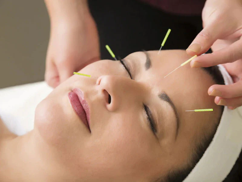 5 Benefits of Acupuncture