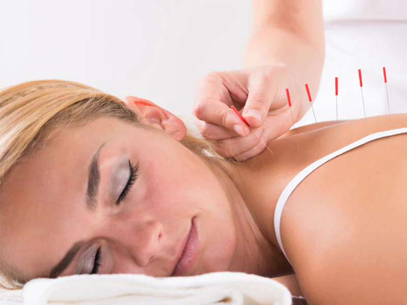 hand performing acupuncture