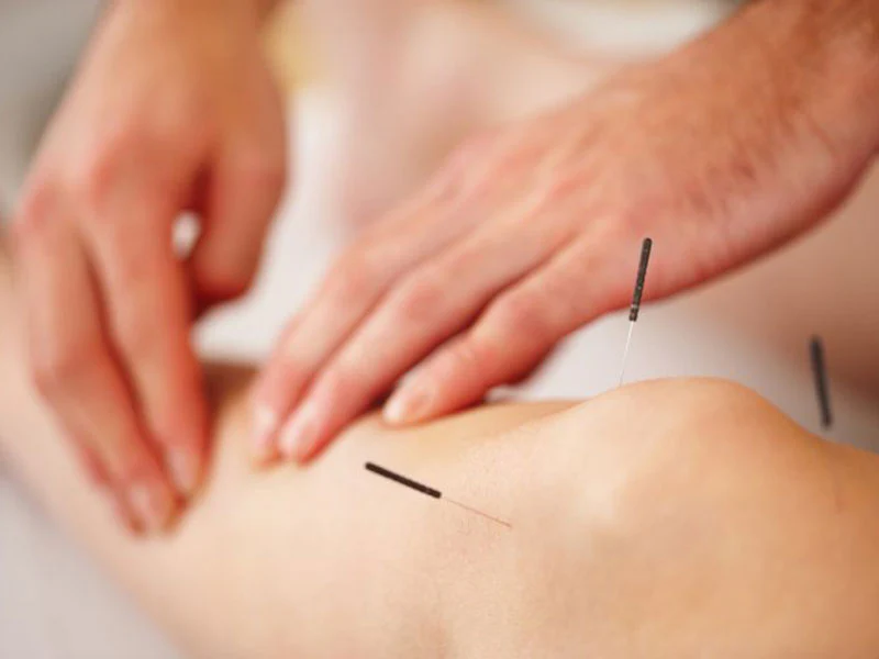 woman treated with acupuncture