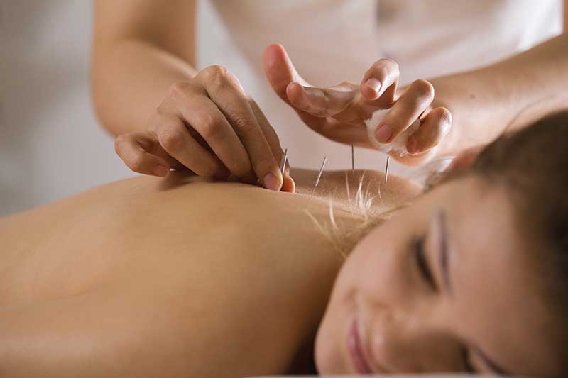 What is Acupuncture?