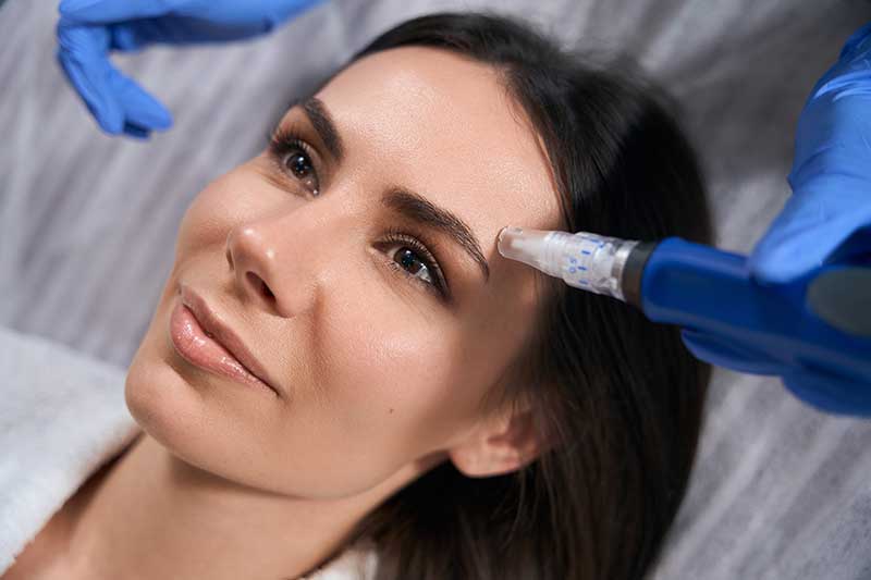 microneedling facial benefits