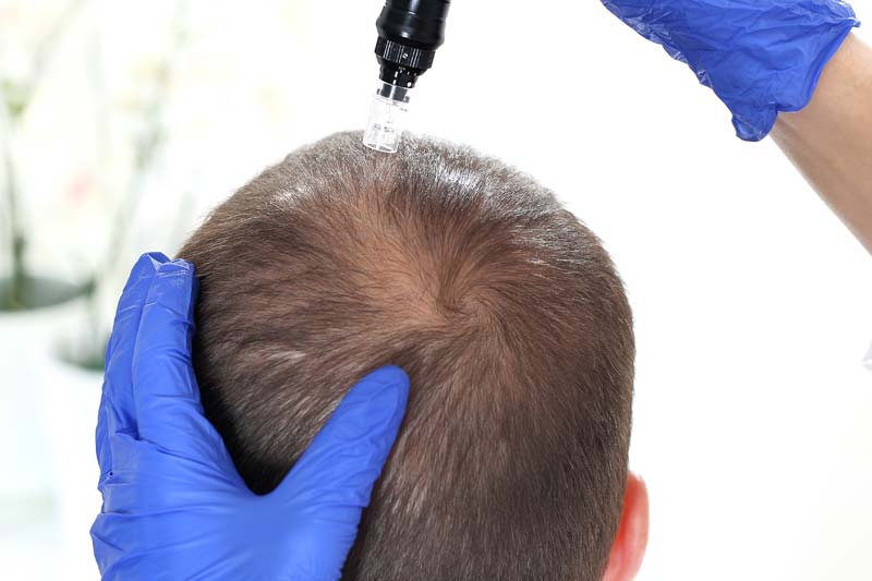 Microneedling for Hair Loss