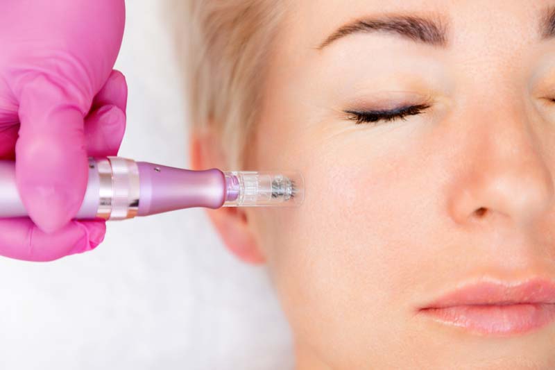 Microneedling for Wrinkles