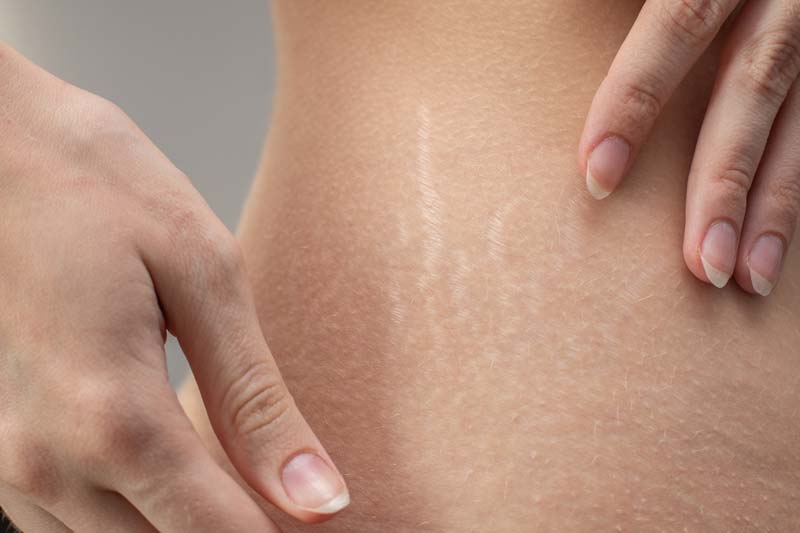 Microneedling for Stretch Marks